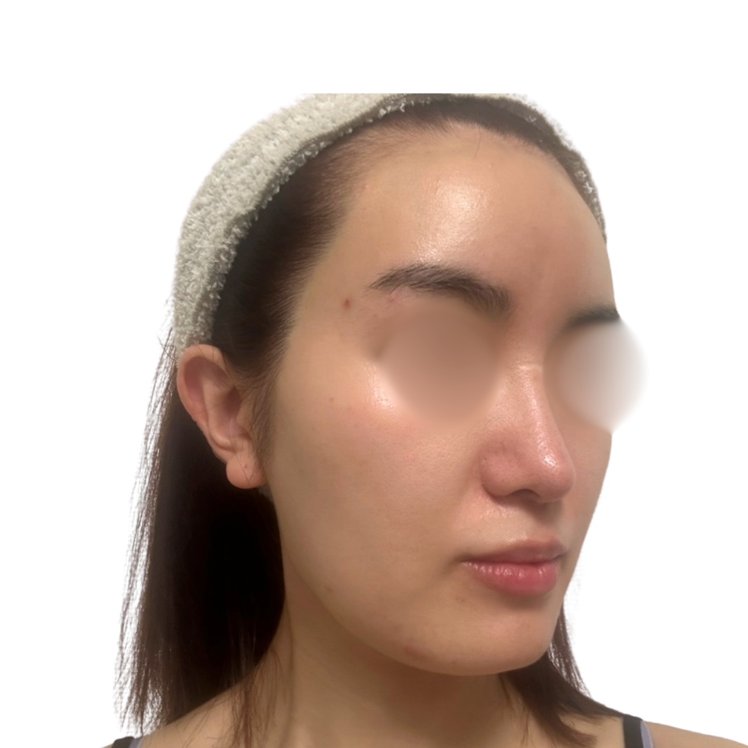 バイオリピール（ミラノリピール）